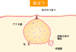 炎症のないニキビ
