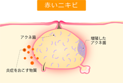 赤いニキビ