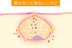 膿をもった黄色いニキビ