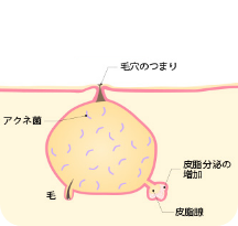 炎症のないニキビ