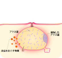 赤いニキビ