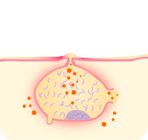 膿をもった黄色いニキビ